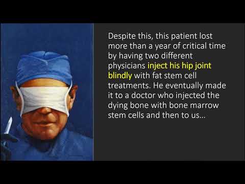 Hip AVN Osteonecrosis Stem Cell Scam
