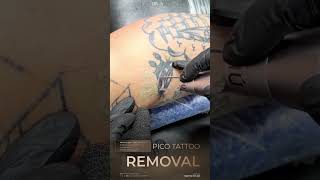 Laser Tattoo Removal at DIVA
