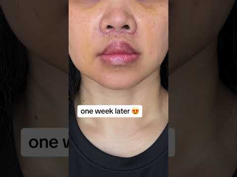 Lip Lift Surgery Results #plasticsurgery #plasticsurgeon #beforeandafter