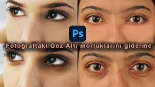 Fotoğrafta göz altı morlukları nasıl düzeltilir?