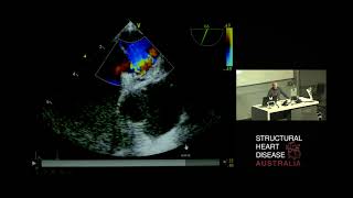 Extracorporeal Membrane Oxygenation for Acute Pulmonary Embolism – A/Prof Paul Forrest