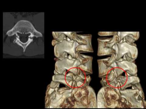 Dolor del nervio ciático en la espalda durante el embarazo Osteocondrosis de la columna cervical. síntomas