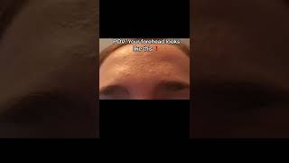 Does your forehead have BUMPS LIKE THAT?!!!!! #skincare  #skincareroutine