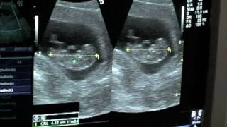 preview picture of video '11 Week Ultrasound'