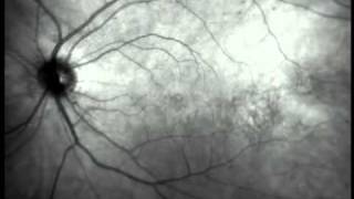 Eye Floaters Video