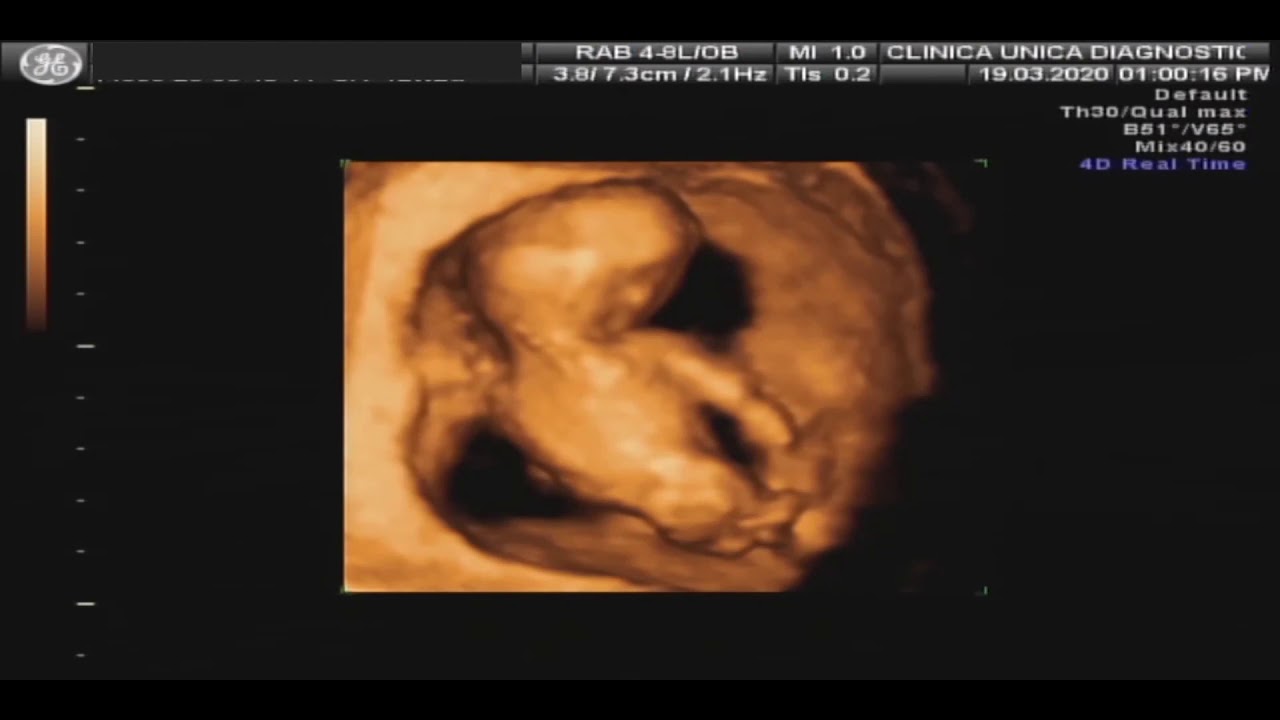 Ultrassom morfológico de primeiro trimestre em 3D