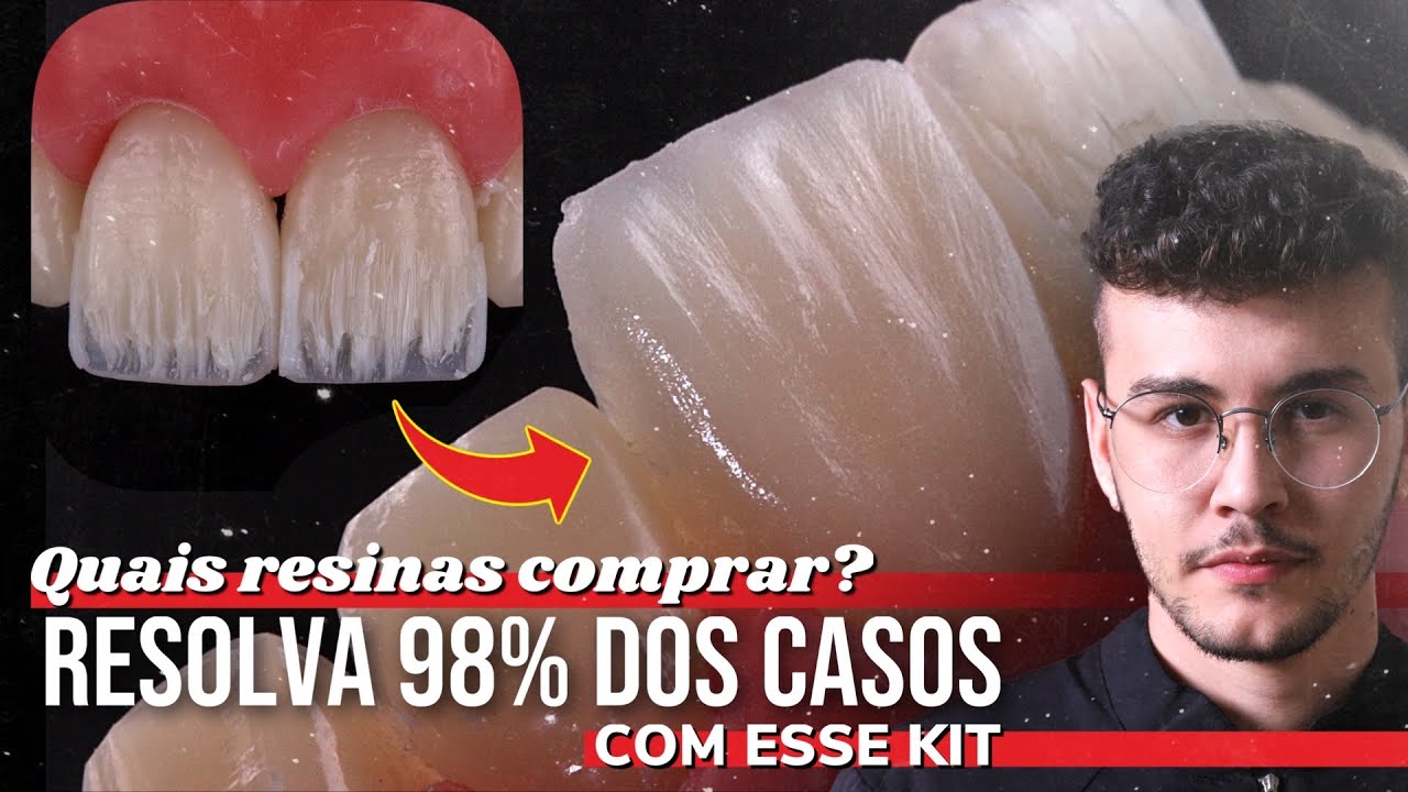 Setup de Resinas para Faceta em Resina composta [Resolva 98% dos casos com esse setup]