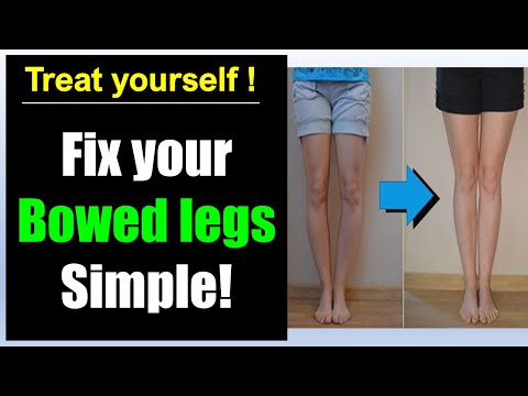 Bowed legs fix! Simple bowed legs exercise correction!