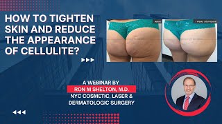 Cellulite reduction in NYC with Resonic & Skin tightening ways