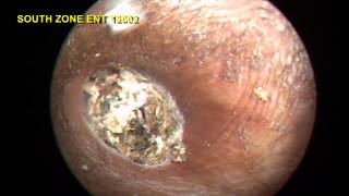 IMPACTED EAR WAX STONY HARD REMOVAL