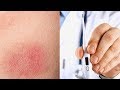 Symptoms of Tick-Borne Illness | Headline [Clip]