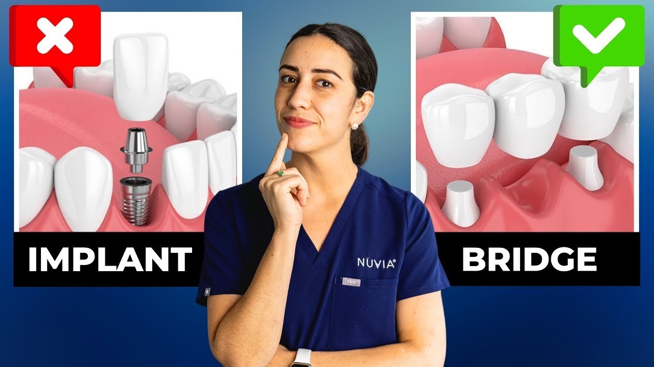 This ONE Thing Changed My Mind about Dental Implants
