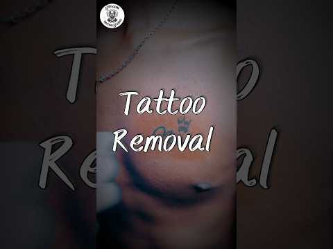 Tattoo Removal Process | Styledotcom