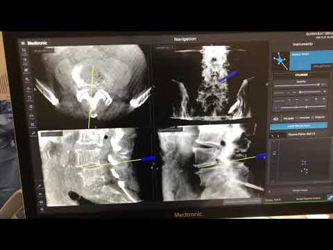 L4-5, L5-S1 MIS TLIF Reconstruction