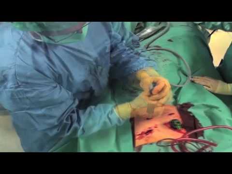 Wund Schultermuskel von der Rückseite Rückenschmerzen aufgrund von Prostatitis