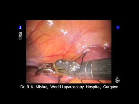 Robotic Laparoscopic Surgery