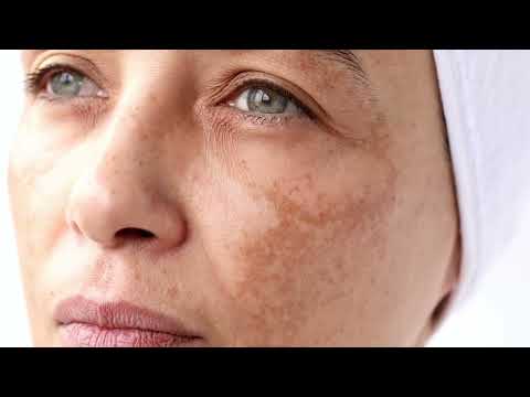 ORIGEN DE TUS MANCHAS ¿ Como se forman las manchas en la piel ? MELANOCITOS