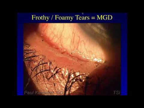 New Understanding in the Treatment of Dry Eye Disease