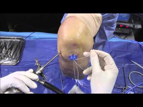 Horizontal Meniscal Tear Repair Using the Knee Scorpion™ Suture Passer