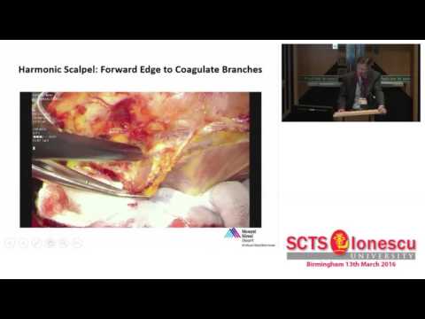 Total Arterial Revascularisation: how I decide