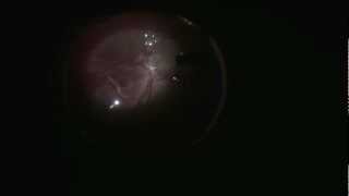 Vitrectomy - Blunt ocular trauma