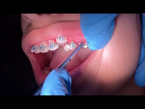 Braces checkup - why do my canines stick out ? - Braces expansion Tooth Time Dentist New Braunfels