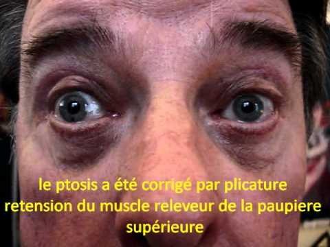comment guerir ptosis