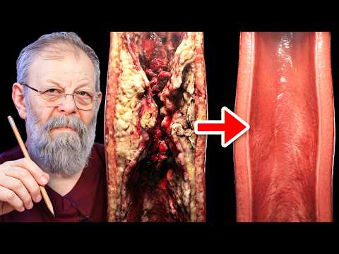 ПОКАЗЫВАЮ КАК КАРАНДАШОМ СПАСТИ СОСУДЫ