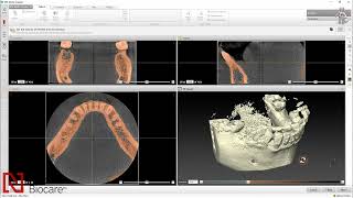 1  How to Import Dicom Scans for Partially Edentulous Case