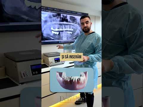 Lucrare dentară distrusă – Dinți cariați și fracturați sub lucrare. Soluția: implanturi dentare!