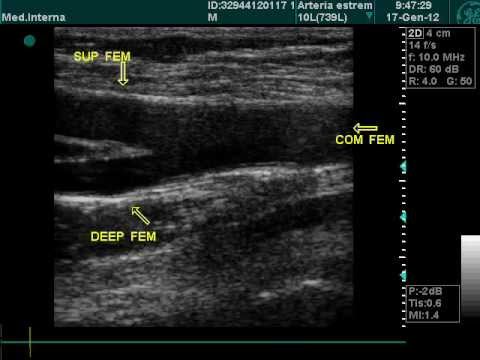 Bifurkation der gemeinsamen Oberschenkelarterie bei der Doppler-Echographie-Untersuchung