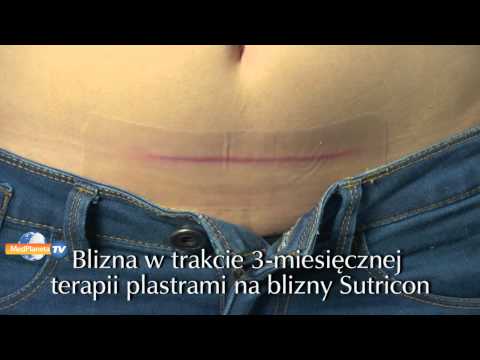 Jak tydzień swing mięśnie Zapalenie mięśnia najszerszego grzbietu