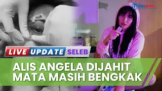 Penampakan Wajah Angela Lee seusai Perban Dibuka, Mata Masih Bengkak Membiru akibat Kecelakaan