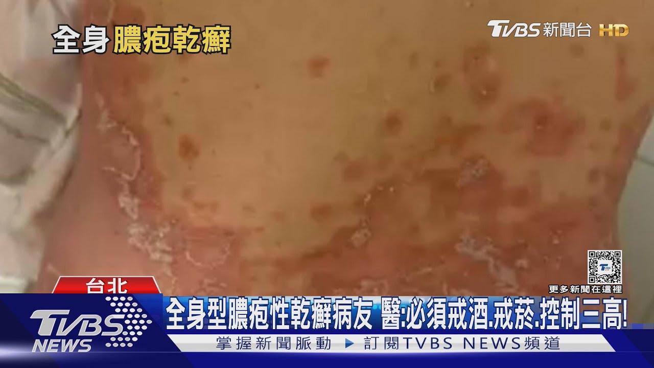 「這部位」出現紅腫身體發冷、發高燒 醫師:恐罹「全身型膿疱性乾癬」