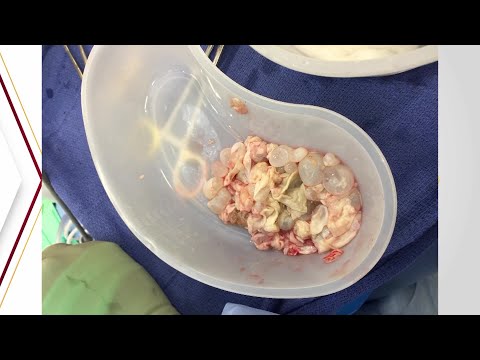 hpv vírus zyste mi okozza a pikkelyes papillómát a nyelven