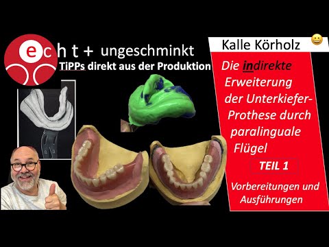 Optimieren d. Prothesenhaltes Teil 1 - im Unterkiefer durch Erweiterung von paralingualen Flügeln