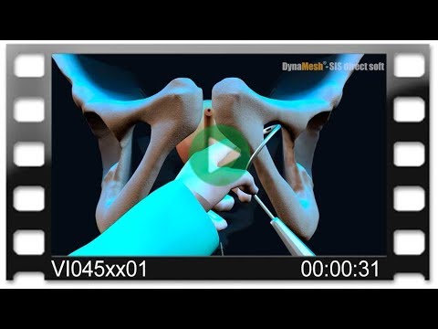 DynaMesh®-SIS direct - Animation: SUI Treatment - Transobturator (out/in) - TOT