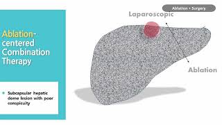 [Conference Talk]  ACTA 2023 Ablation-centered Combination Therapy (Live)