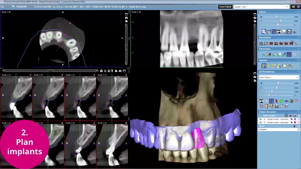 Planmeca Romexis – the complete dental implant workflow