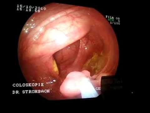 Penester und Prostatakrebs Schmerzen in Prostatitis Ei