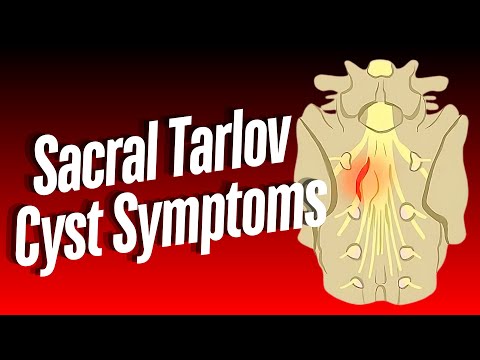 Sacral Tarlov Cyst Symptoms: Insights from 100 Patients