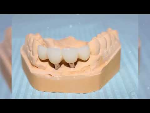 Mia Dental Implant video