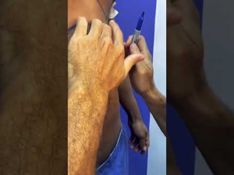 Marcación abdominal en hombres Cartagena y Bogotá realizada por el cirujano plástico Carlos Zuleta