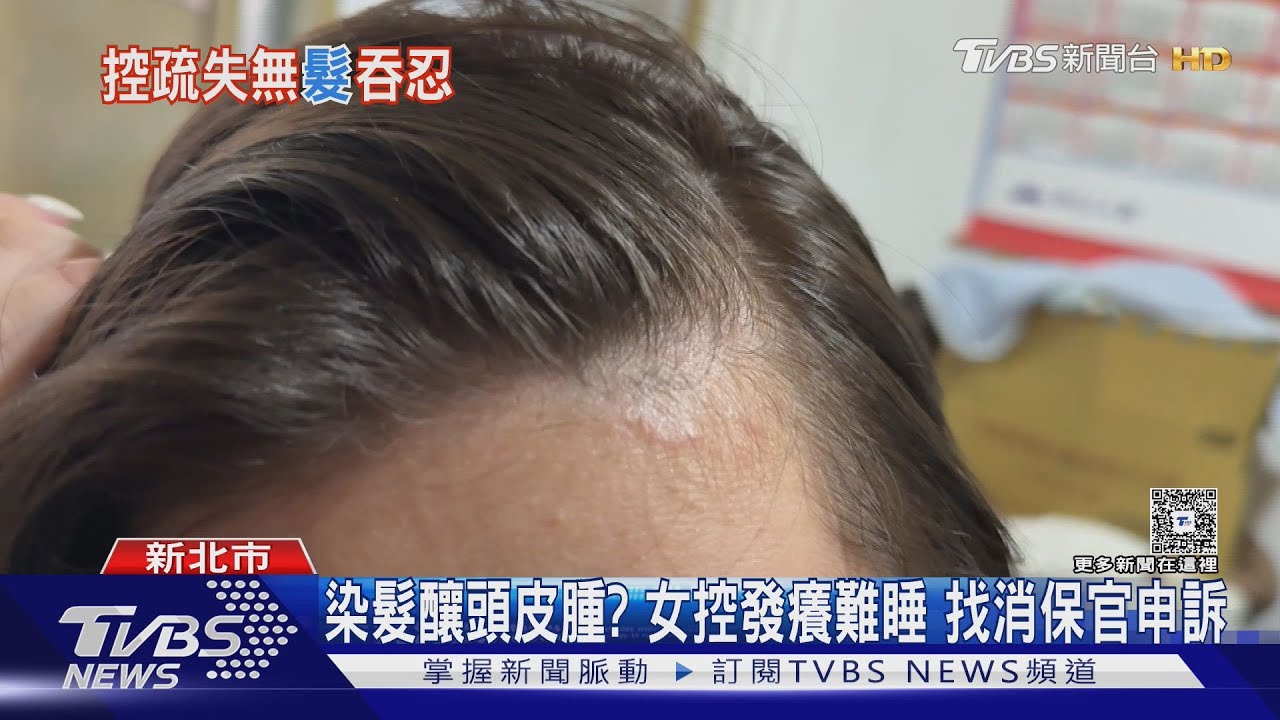 染髮釀頭皮腫?女控發癢難睡 找消保官申訴