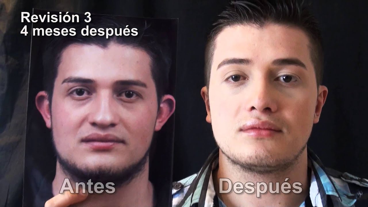 Otoplastia, Rinoplastia Antes y Después Medellín Colombia