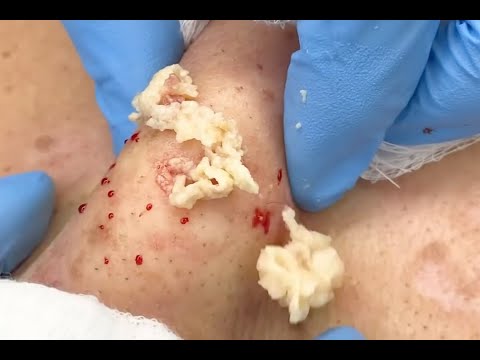 Large CYST removal