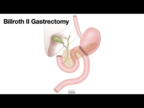 HCC 1475-10c-Surgical Anatomy-Billroth II