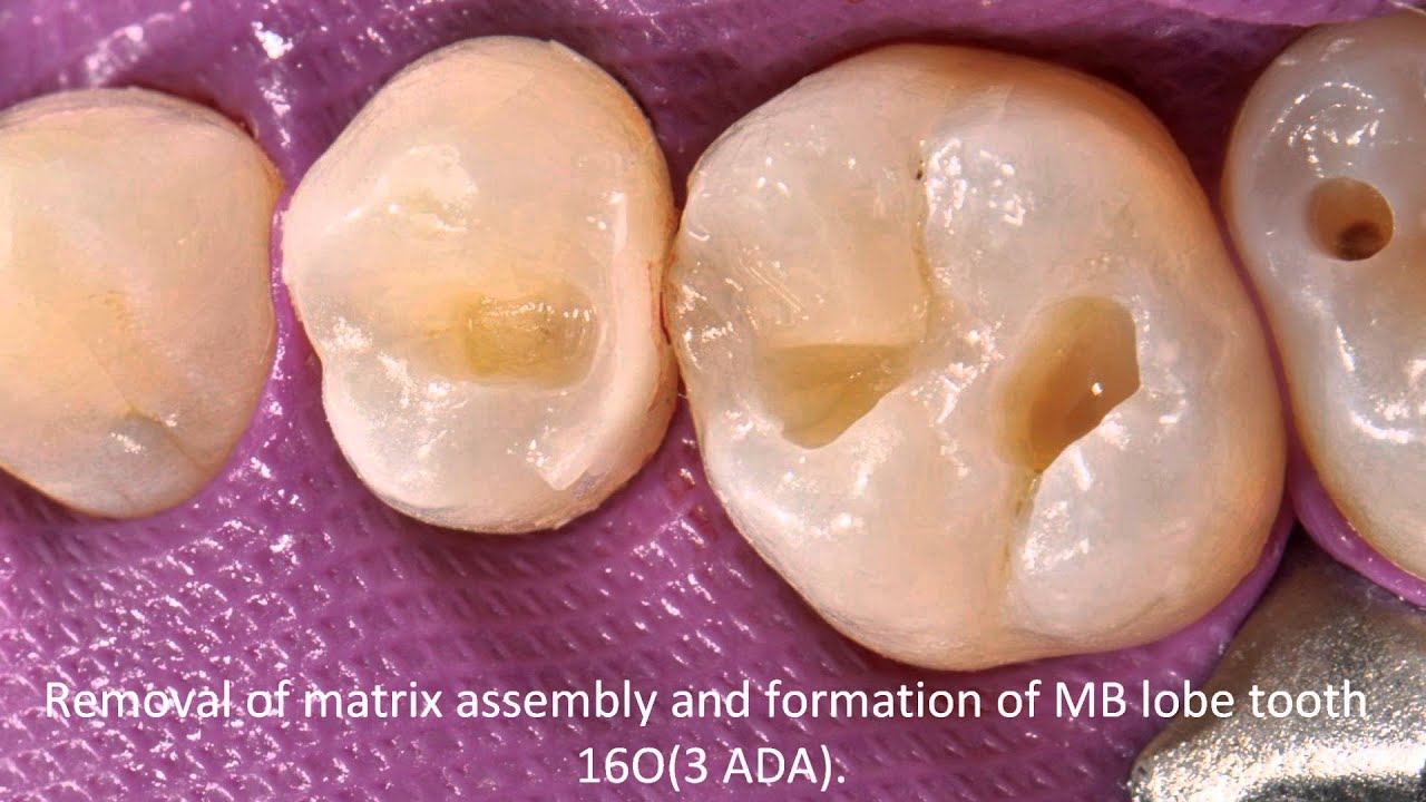 V3/SDR Clinical Case Study by Dr Clarence Tam