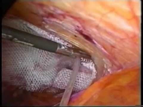 Esercizi con instabile scheda video vertebre cervicali Cosa fare iniezioni per il dolore alle articolazioni