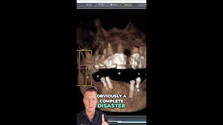 From Implant Nightmare to Dream Smile - A Dental Rescue